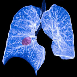 Desarrollan un programa de IA que predice el riesgo de c&aacute;ncer de pulm&oacute;n