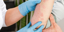 El diagn&oacute;stico temprano de la psoriasis pustulosa generalizada es clave para evitar complicaciones, seg&uacute;n dermat&oacute;loga