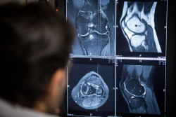 El reemplazo de rodilla, m&aacute;s doloroso para las mujeres posmenop&aacute;usicas con deficiencia de vitamina D