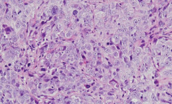 Investigadores del CSIC identifican una prote&iacute;na implicada en la supervivencia de las pacientes con c&aacute;ncer de ovario