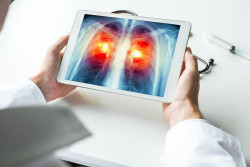 Un m&eacute;todo de ensayo de f&aacute;rmacos descubre una combinaci&oacute;n eficaz para tratar el c&aacute;ncer de pulm&oacute;n de c&eacute;lulas peque&ntilde;as