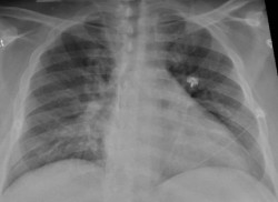  Un nuevo atlas celular de los pulmones revela por qu&eacute; el virus es mortal y diferente